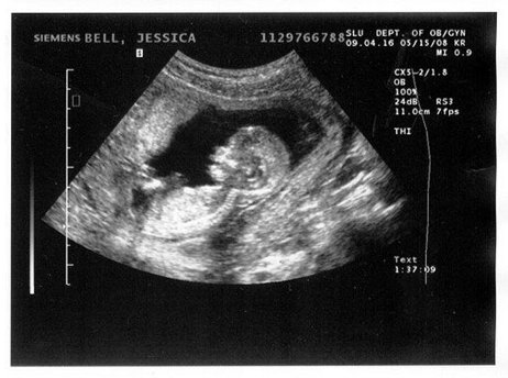 УЗИ акушерское во 2-3 триместре беременности с доплерографией